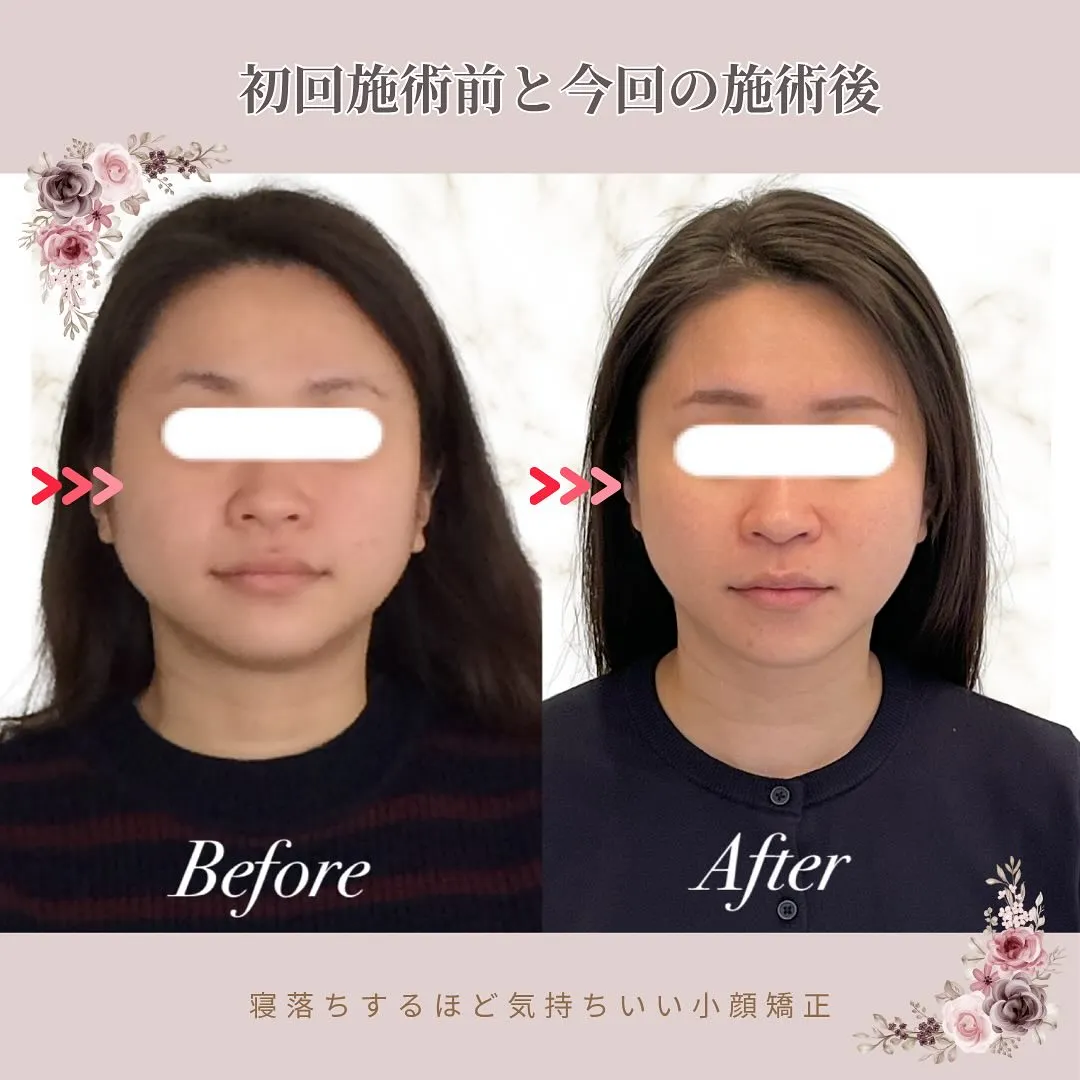 【京都 小顔矯正】💆‍♀️エラ張り・たるみ・むくみ…気になる...
