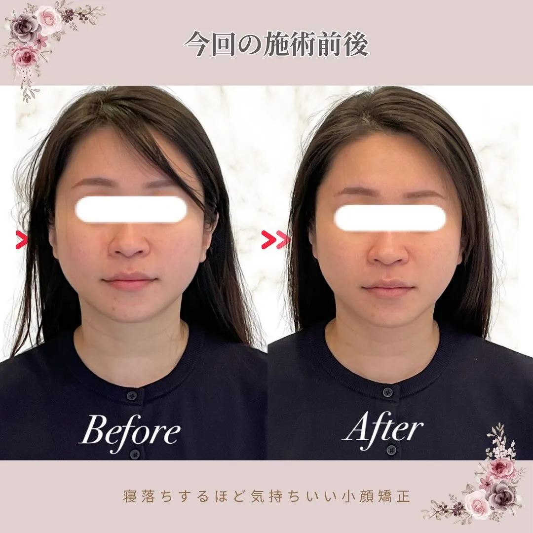 【京都 小顔矯正】💆‍♀️エラ張り・たるみ・むくみ…気になる...