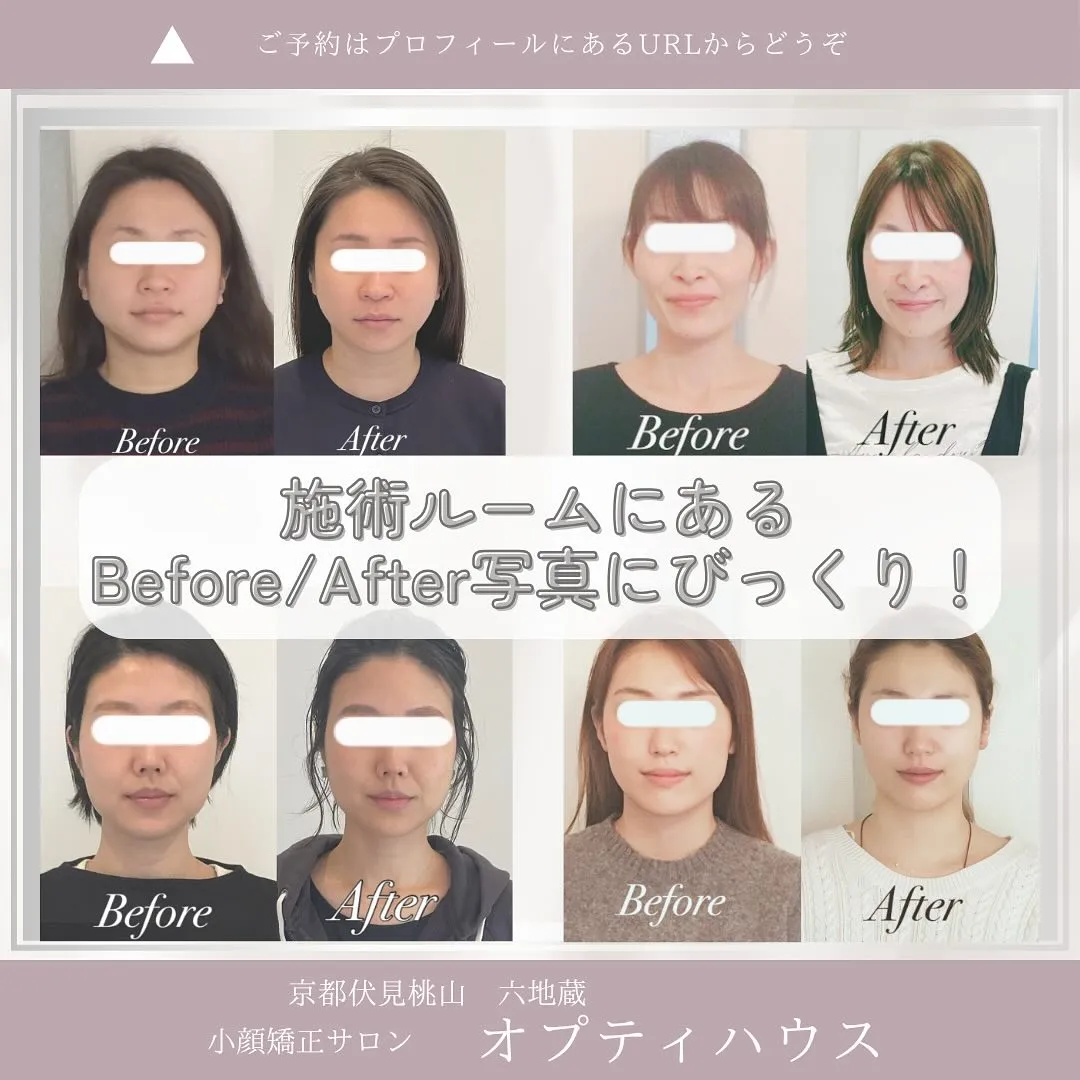 【🌿エラ張りにお悩みの方へ｜京都の痛くない小顔矯正✨】