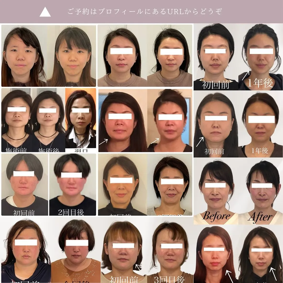 【🌿エラ張りにお悩みの方へ｜京都の痛くない小顔矯正✨】