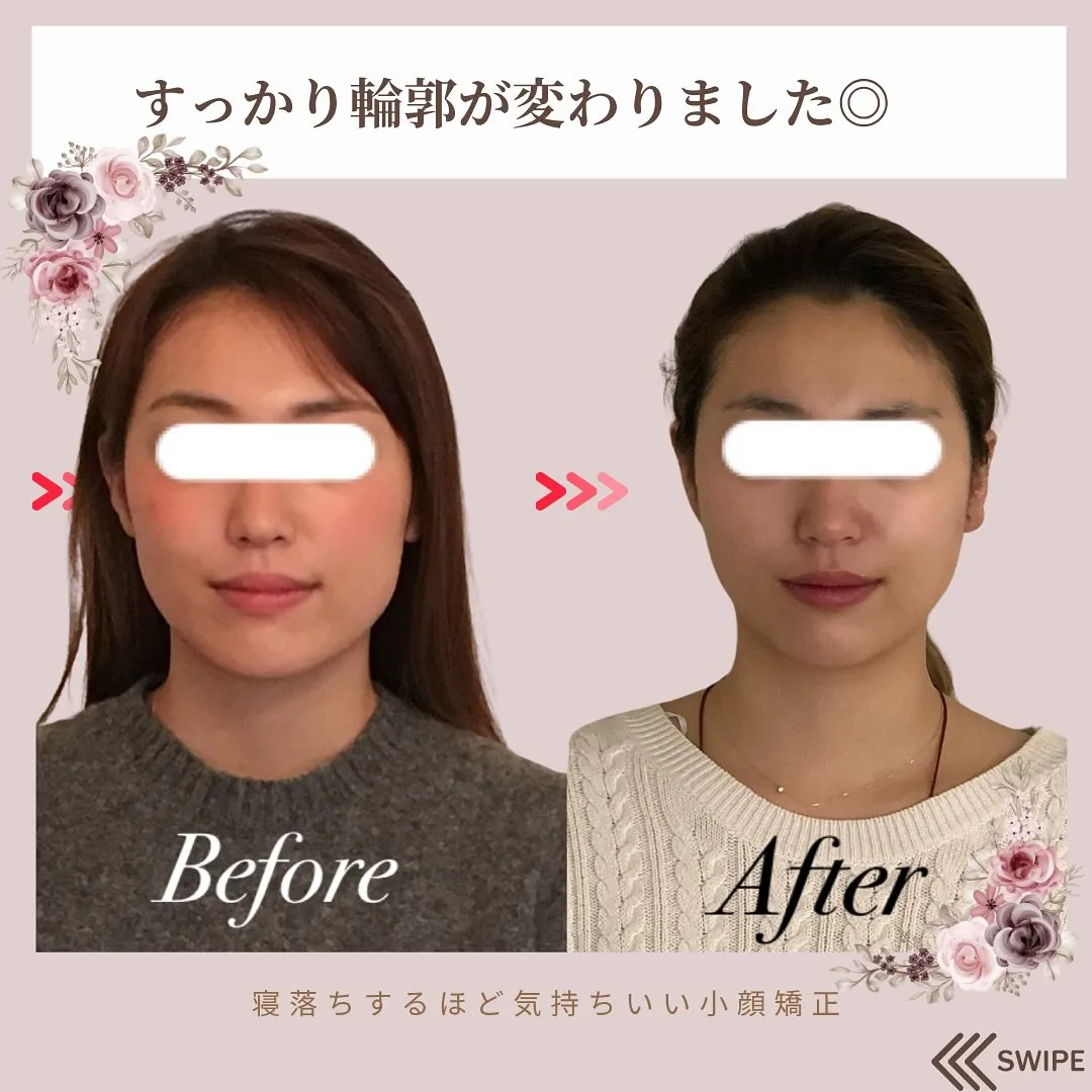 📢 大切なイベント前に小顔矯正 💖京都伏見