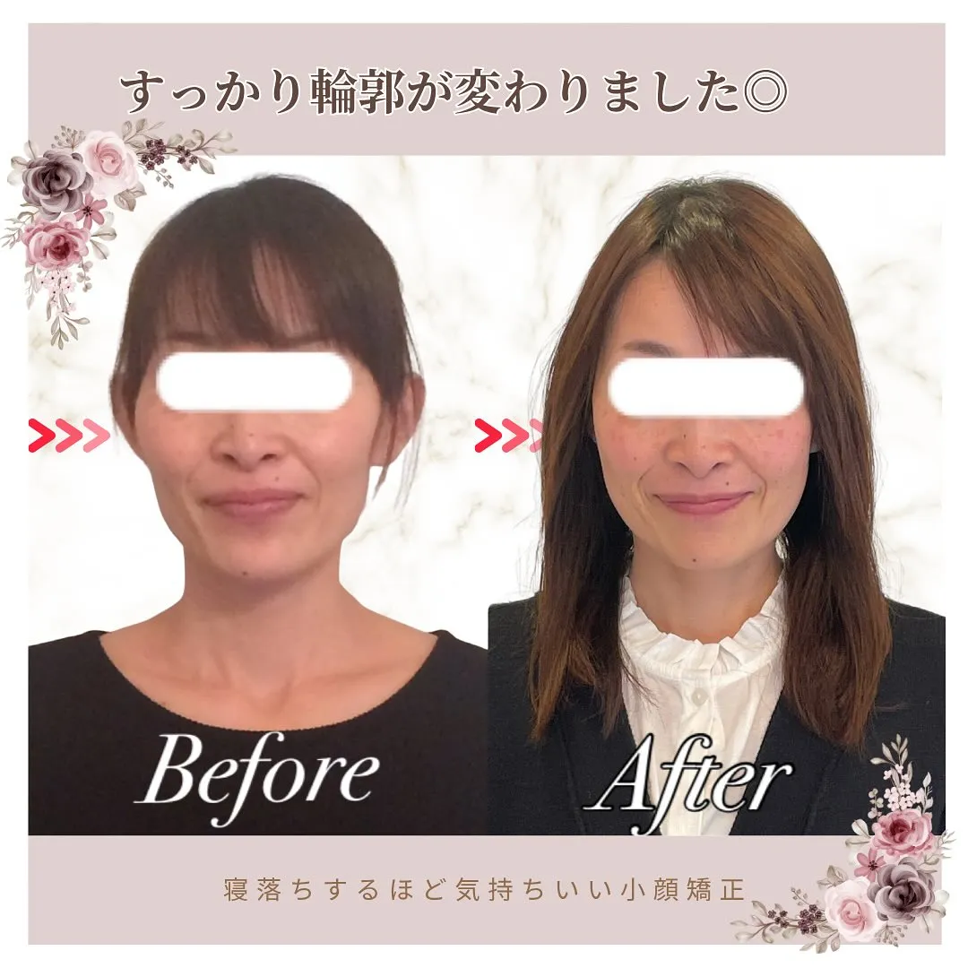 🌸 頬骨・エラ張り改善【京都市伏見区小顔矯正】💆‍♀️✨
