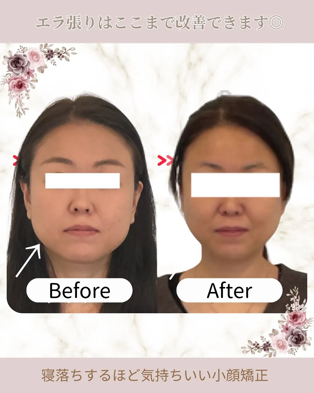 ✨ここまで変化！エラ張り改善✨