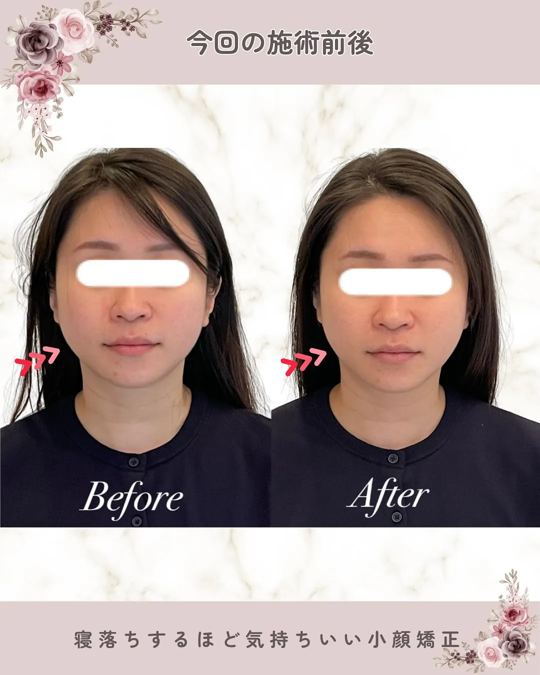 【京都 小顔矯正】💆‍♀️エラ張り・たるみ・むくみ…気になる...