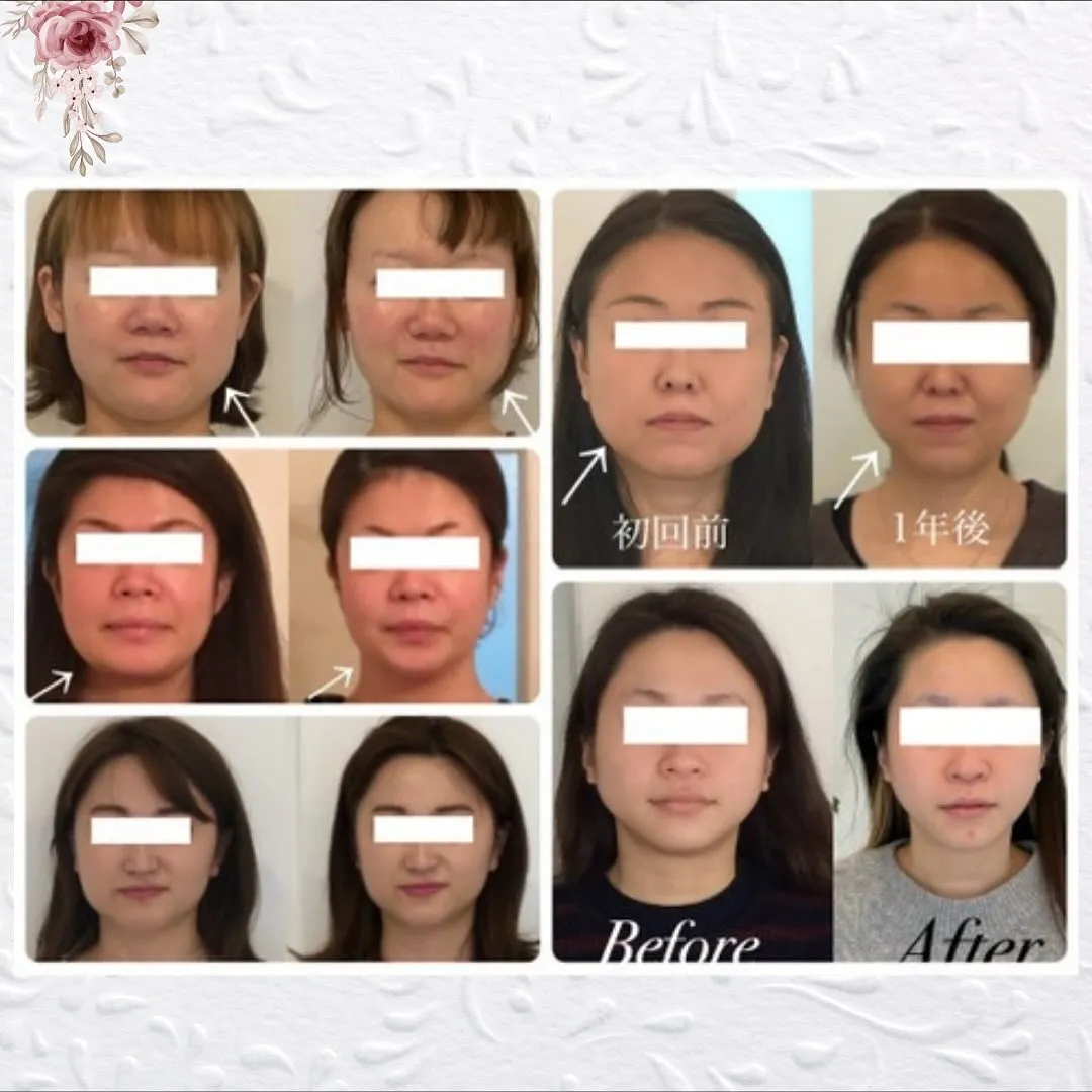 🌟【京都 小顔矯正】一番綺麗になる最適な施術間隔🌟