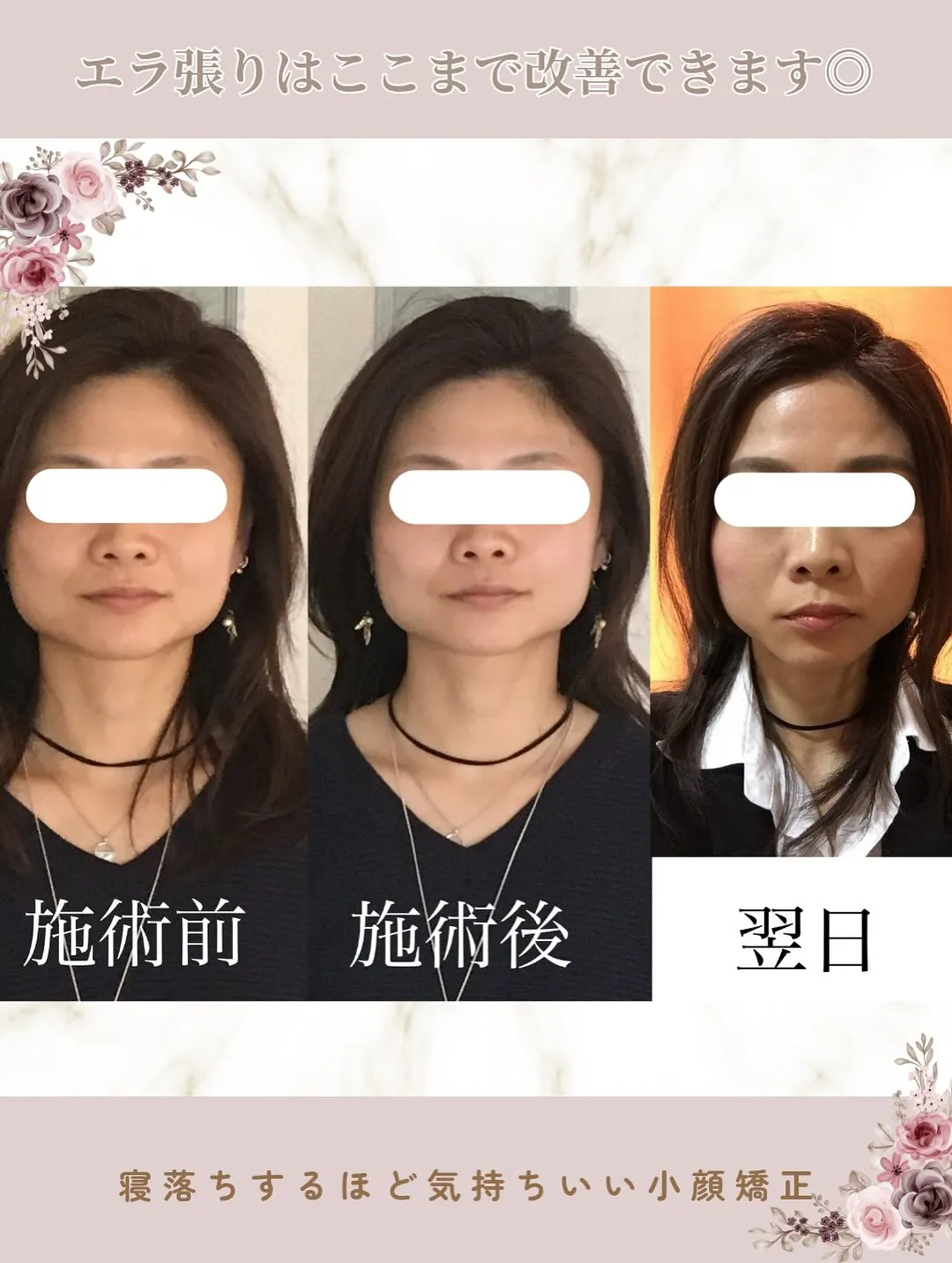 🌸エラ張りでお悩みの方へ🌸【京都市伏見区小顔矯正】🌸