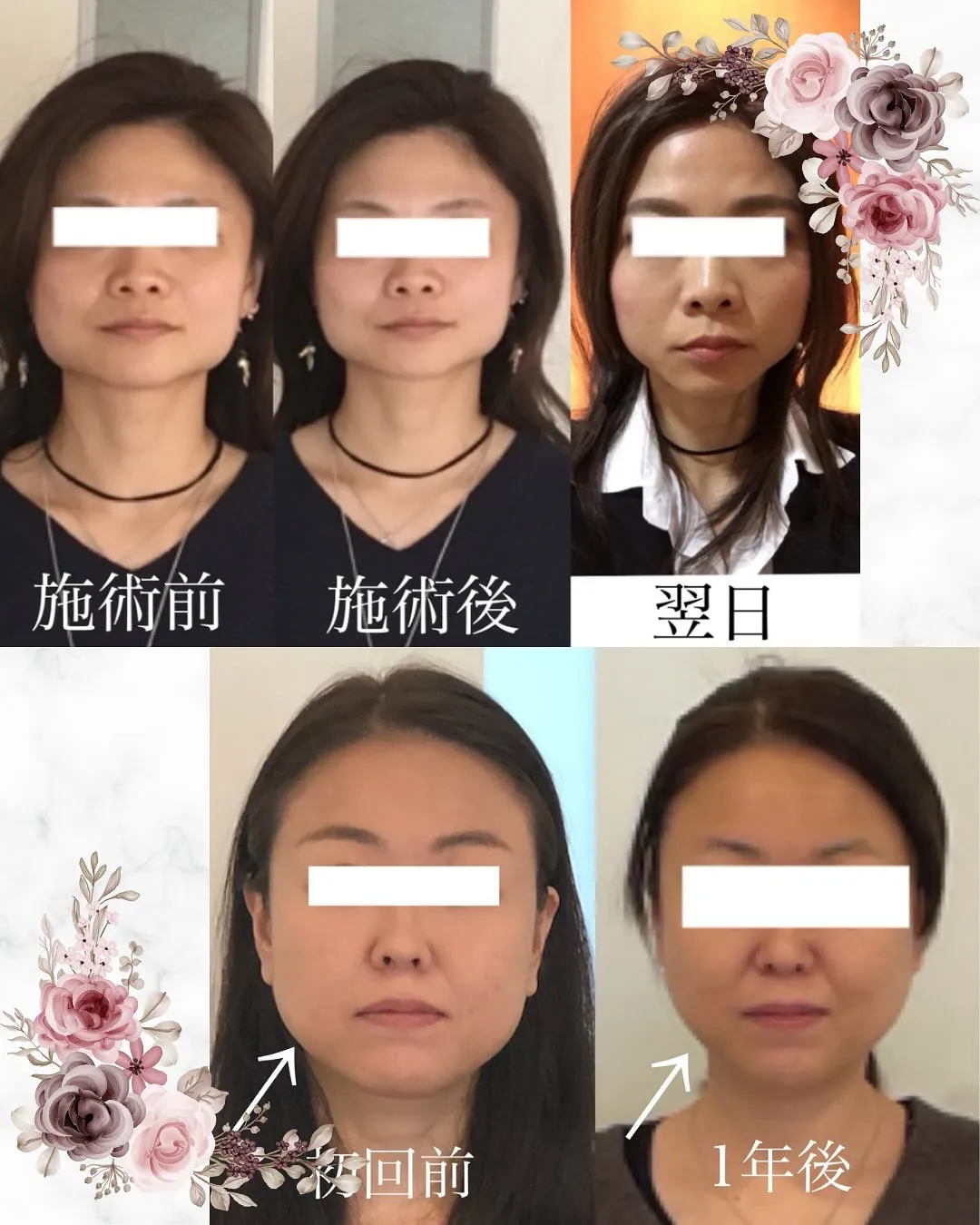 ✨【初回の小顔矯正で驚きの変化✨】✨