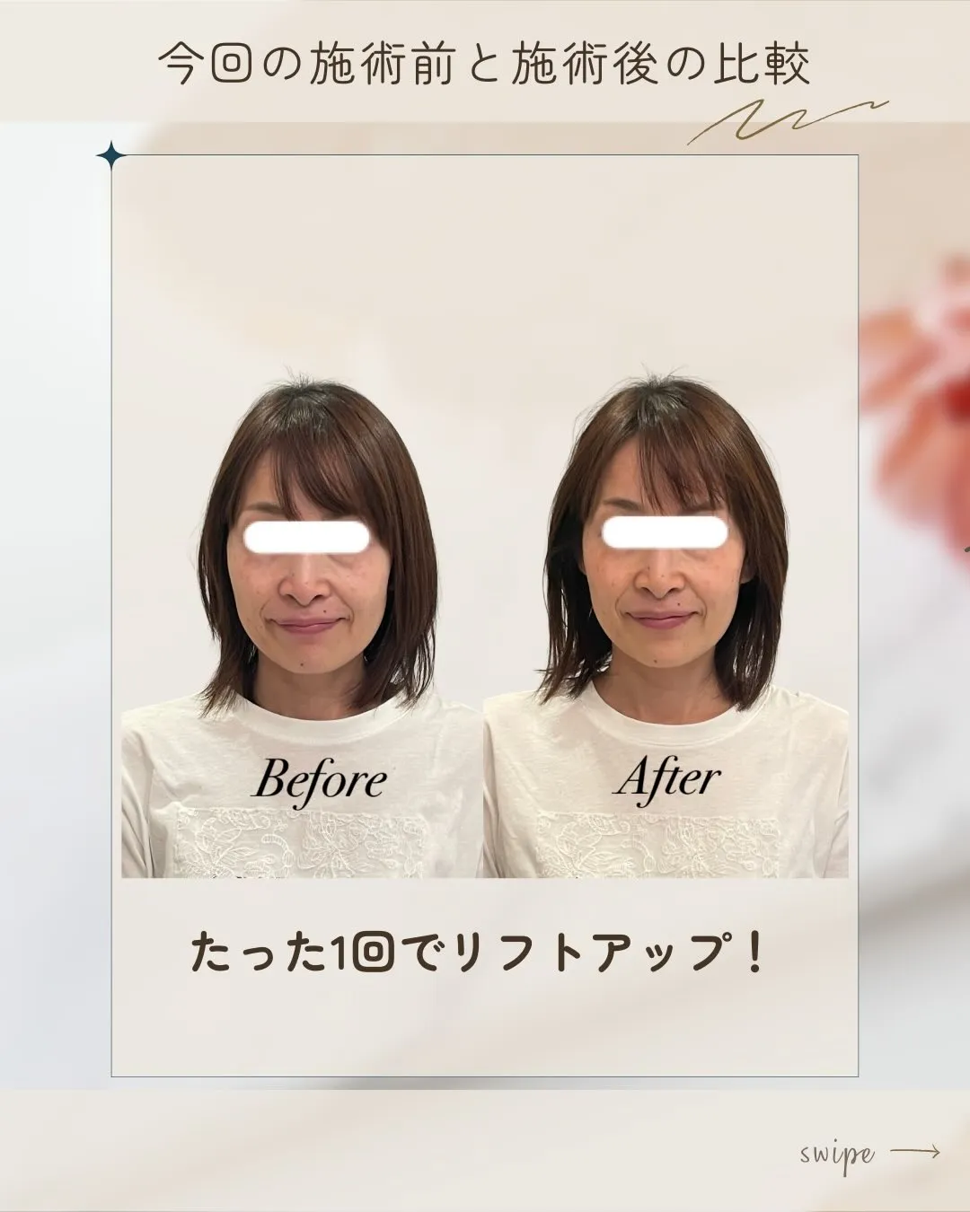 🌸 頬骨・エラ張り改善【京都市伏見区小顔矯正】💆♀️✨