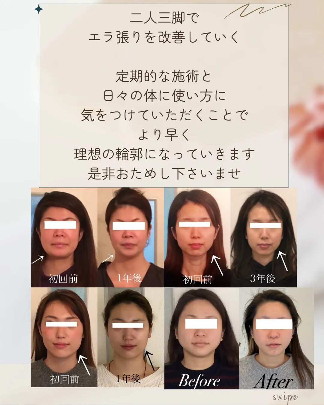 🌸エラ張りでお悩みの方へ🌸【京都市伏見区小顔矯正】🌸