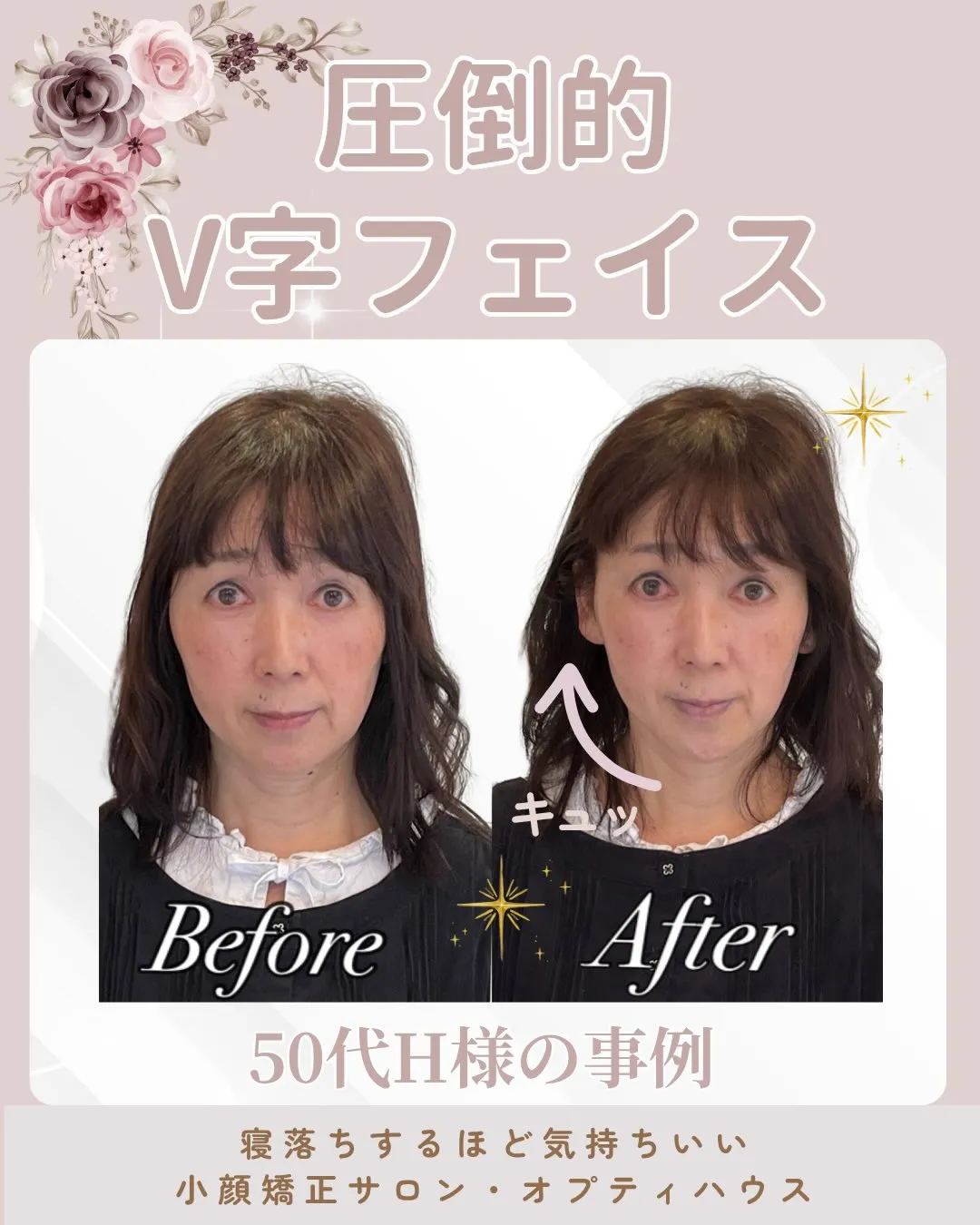 ✨📢【圧倒的V字フェイス✨】1回でここまで変わります🌸 京都...
