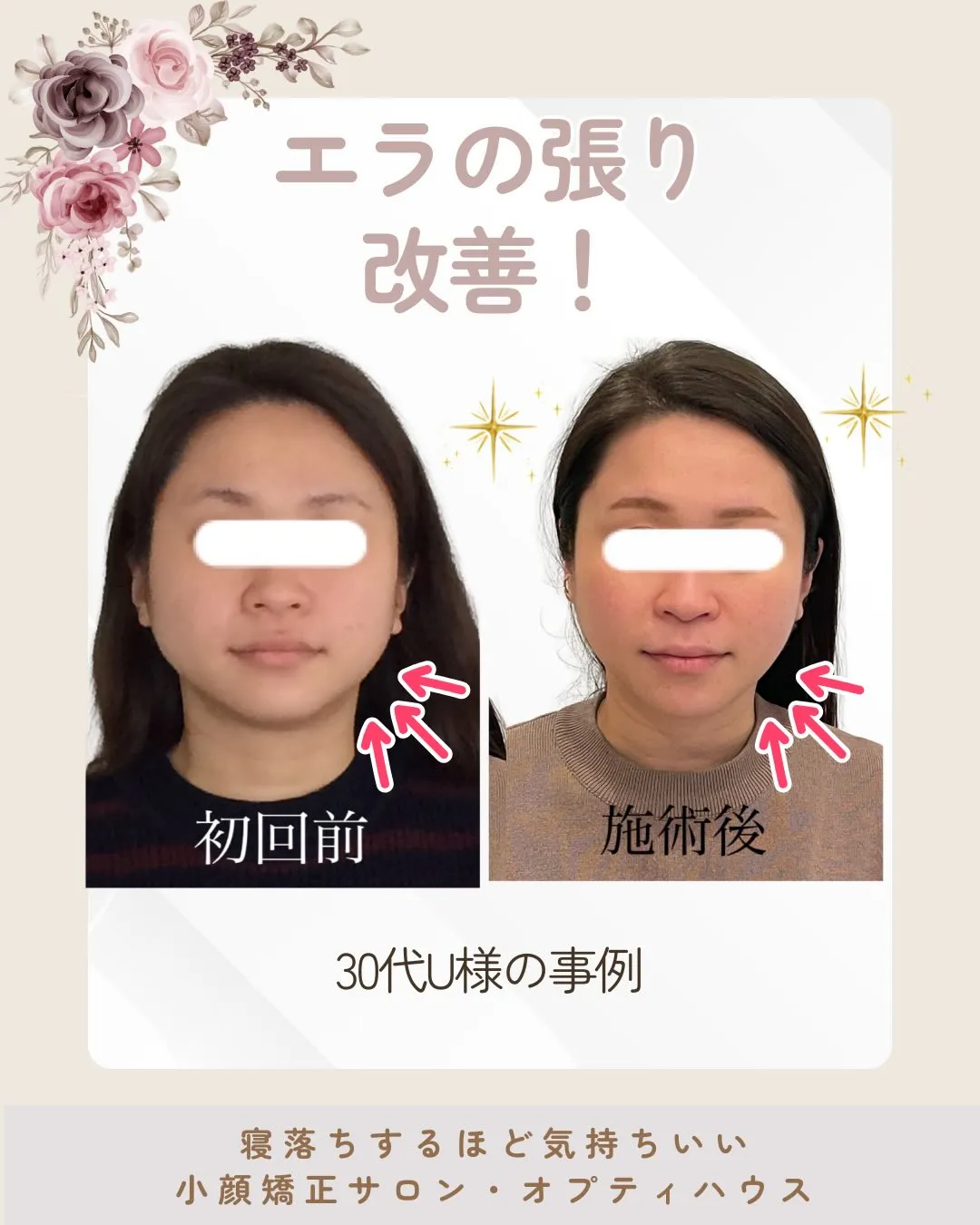 【京都 小顔矯正】💆‍♀️エラ張り・たるみ・むくみ…気になる...