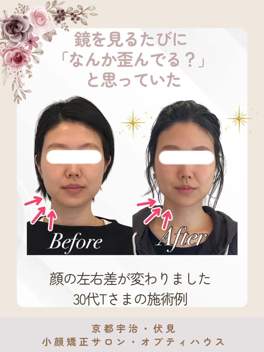 ✨【京都市小顔矯正】👀 顔の左右差、骨格のせいだとあきらめて...