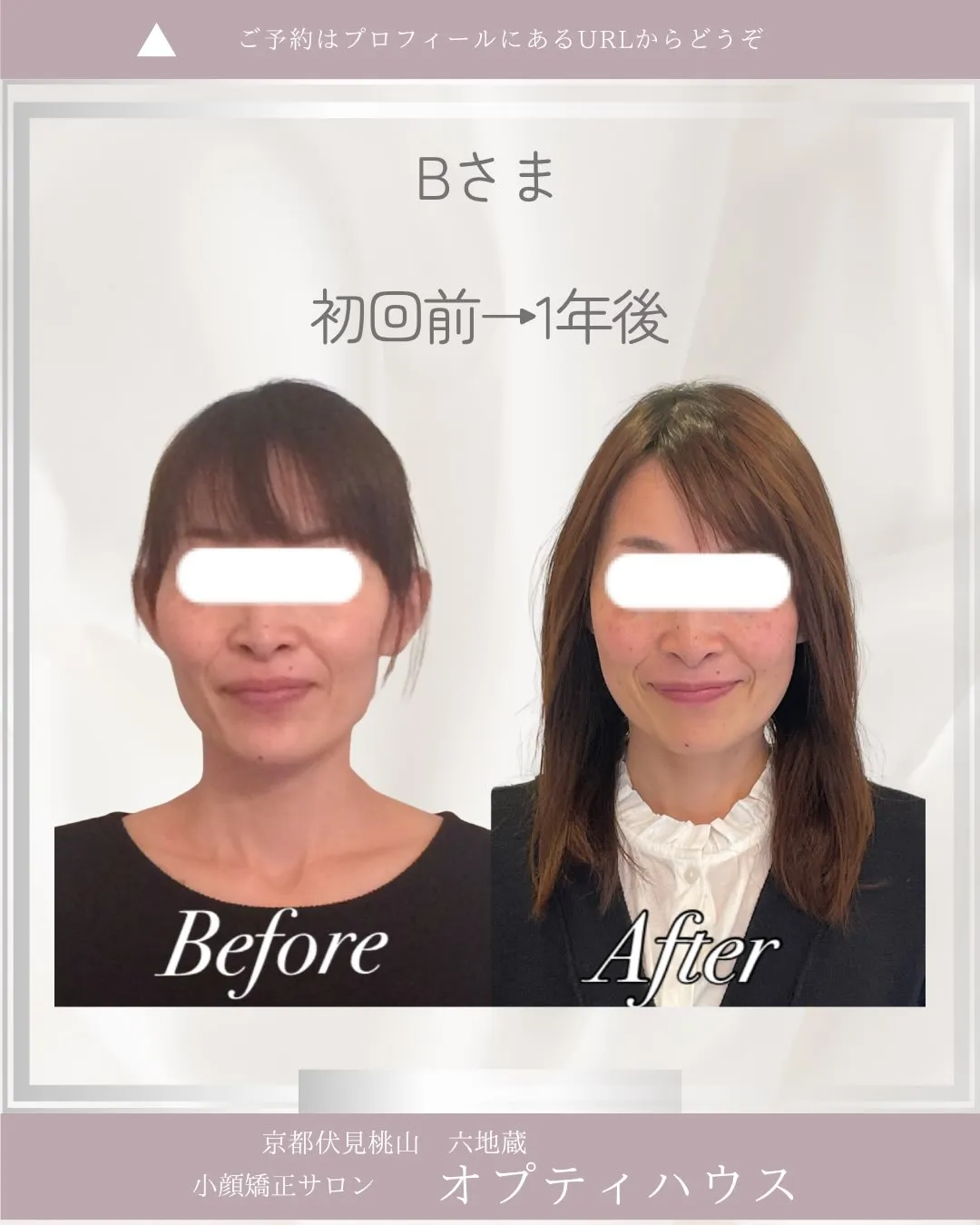 ✨小顔矯正を1年続けると、どう変わるの？✨