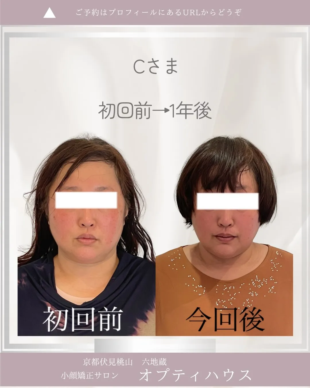 ✨小顔矯正を1年続けると、どう変わるの？✨