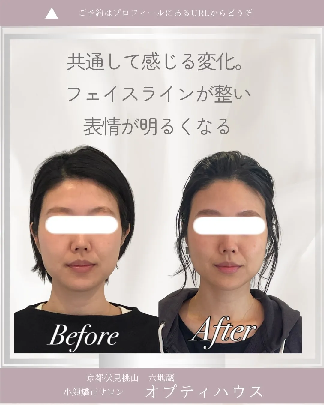 ✨小顔矯正を1年続けると、どう変わるの？✨