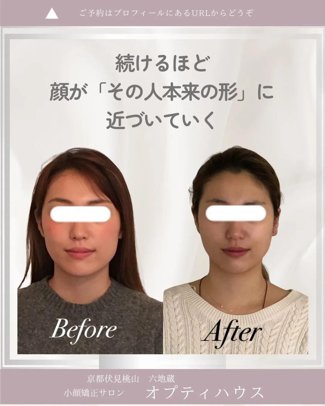 ✨小顔矯正を1年続けると、どう変わるの？✨