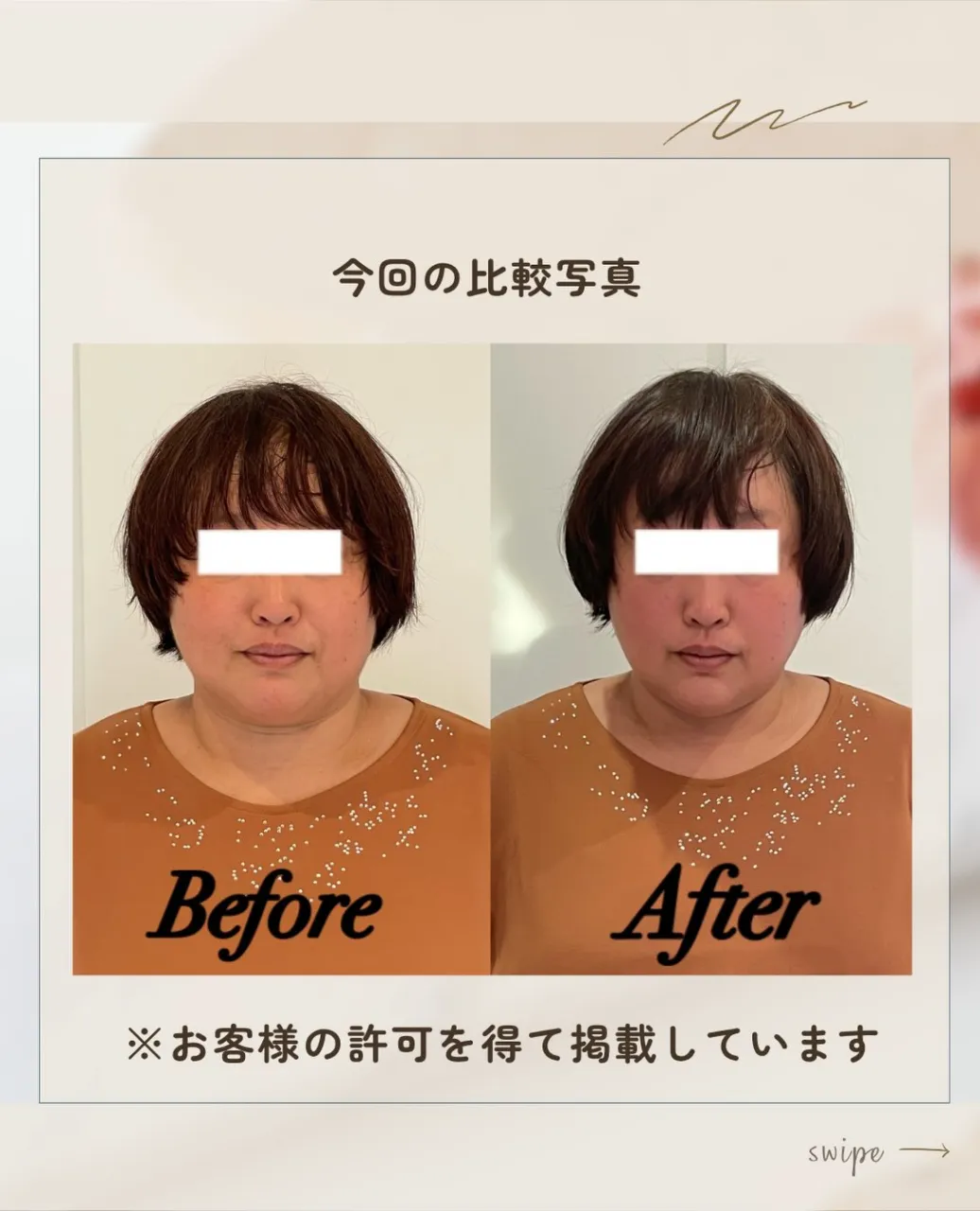 ✨50代・60代のフェイスライン悩みに｜京都・伏見の痛くない...